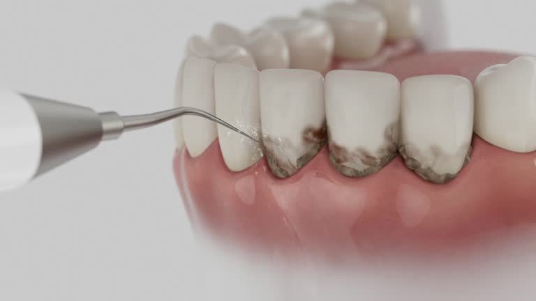 Reliable Dental Implants contractor in Elma, WA by Smile Center Dentistry